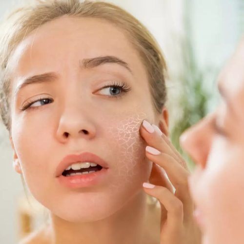 dry skin