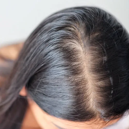 hair loss treatment