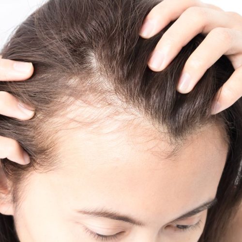 hairfall