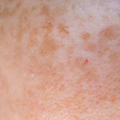 Extreme close-up of freckled Caucasian skin displaying texture and natural pigmentation.