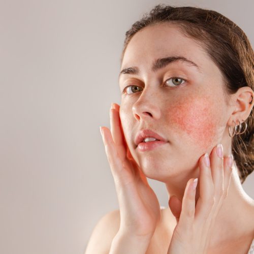 medicine and cosmetology. portrait of a young beautiful brunette woman with rosacea on her cheeks. copy space